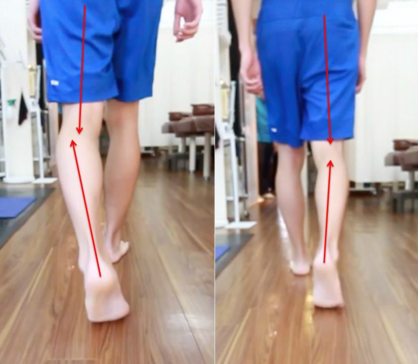 新中野　大木接骨院　歩行　姿勢　歩き方　ケガ治療　側副靭帯損傷　半月板損傷