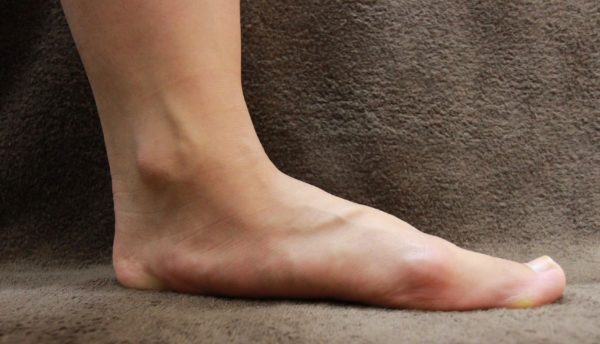 足関節捻挫が多発する扁平足の足