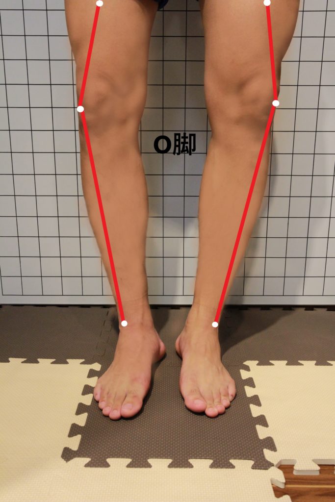 様々な怪我の要因となるO脚の足