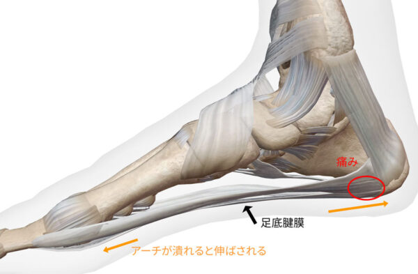 足底腱膜炎の原因