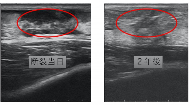 アキレス腱断裂当時と２年後の超音波検査画像