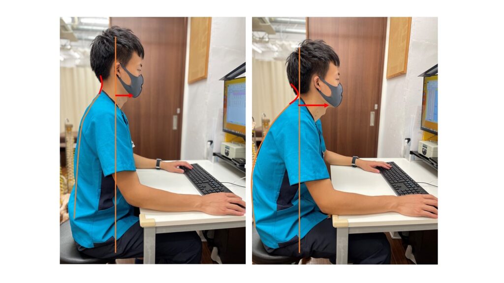 猫背による首痛