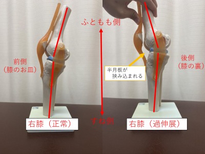 骨模型による膝の過伸展