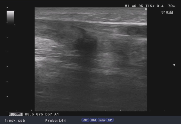 アキレス腱断裂の超音波観察画像2