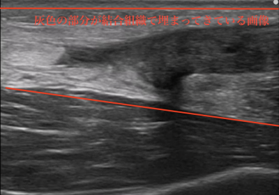 アキレス腱断裂から2週間後のエコー画像