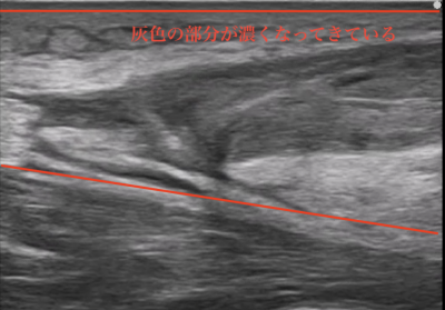 アキレス腱断裂から4週間後のエコー画像