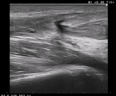 アキレス腱断裂から12週間後のエコー画像