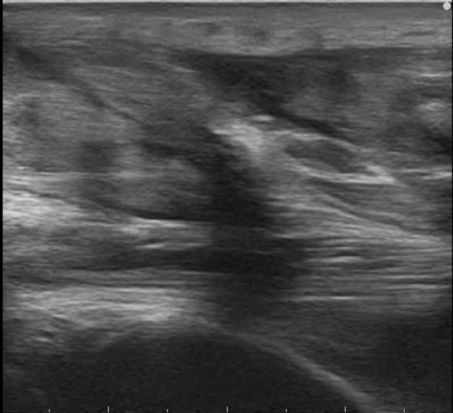 アキレス腱断裂から２日後のエコー画像