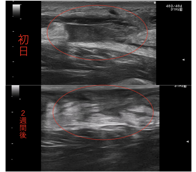 アキレス腱断裂のエコー比較画像