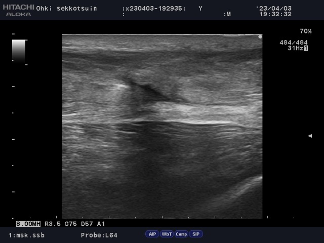 アキレス腱断裂から約4週間後の超音波検査画像