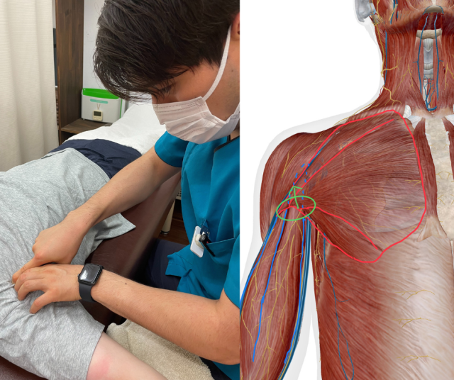 四十肩・五十肩に対する大胸筋の筋膜リリース