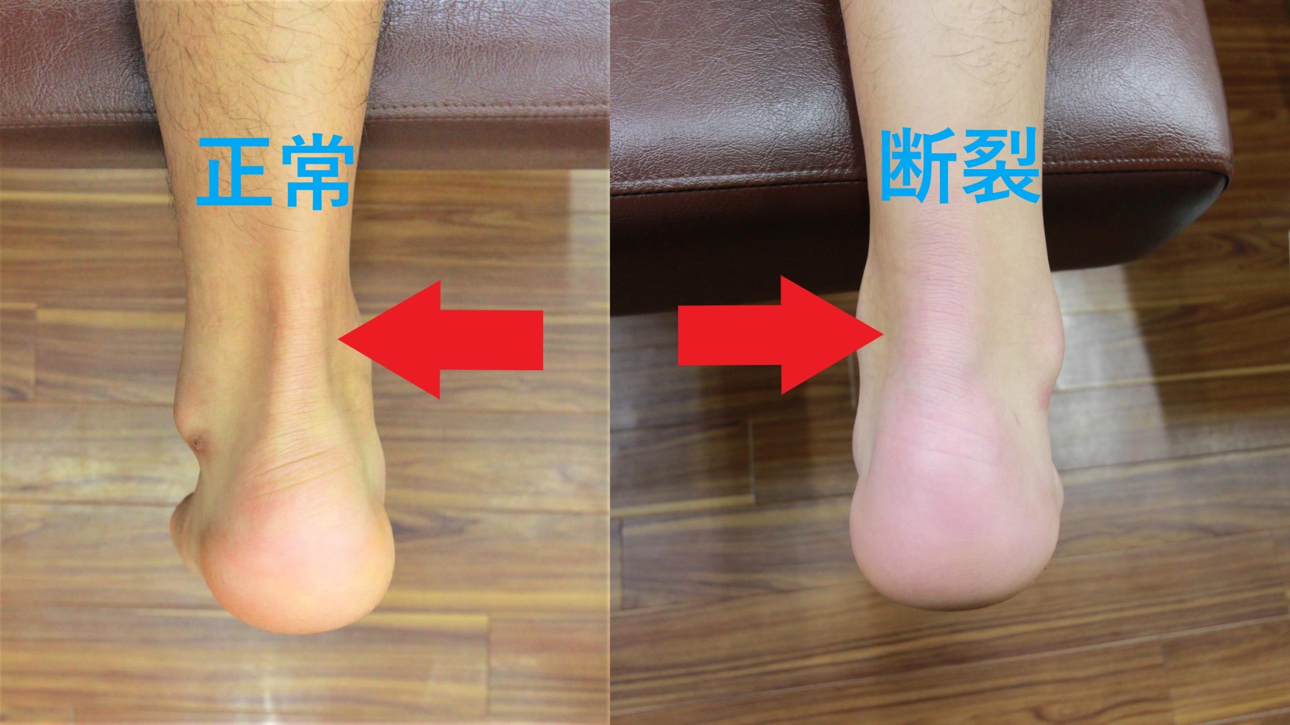 【症例】接骨院スタッフがアキレス腱断裂①