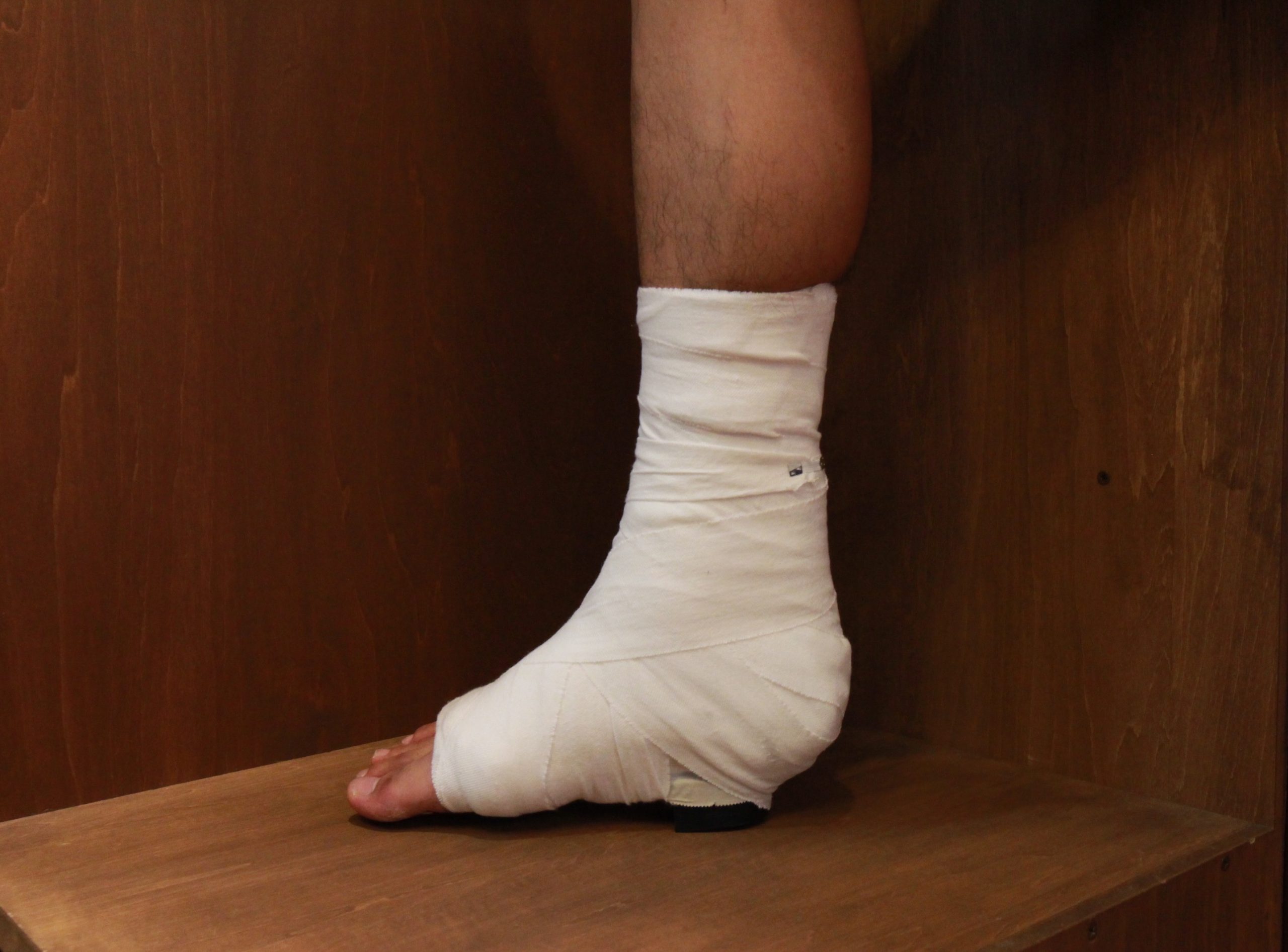 【症例】接骨院スタッフがアキレス腱断裂②